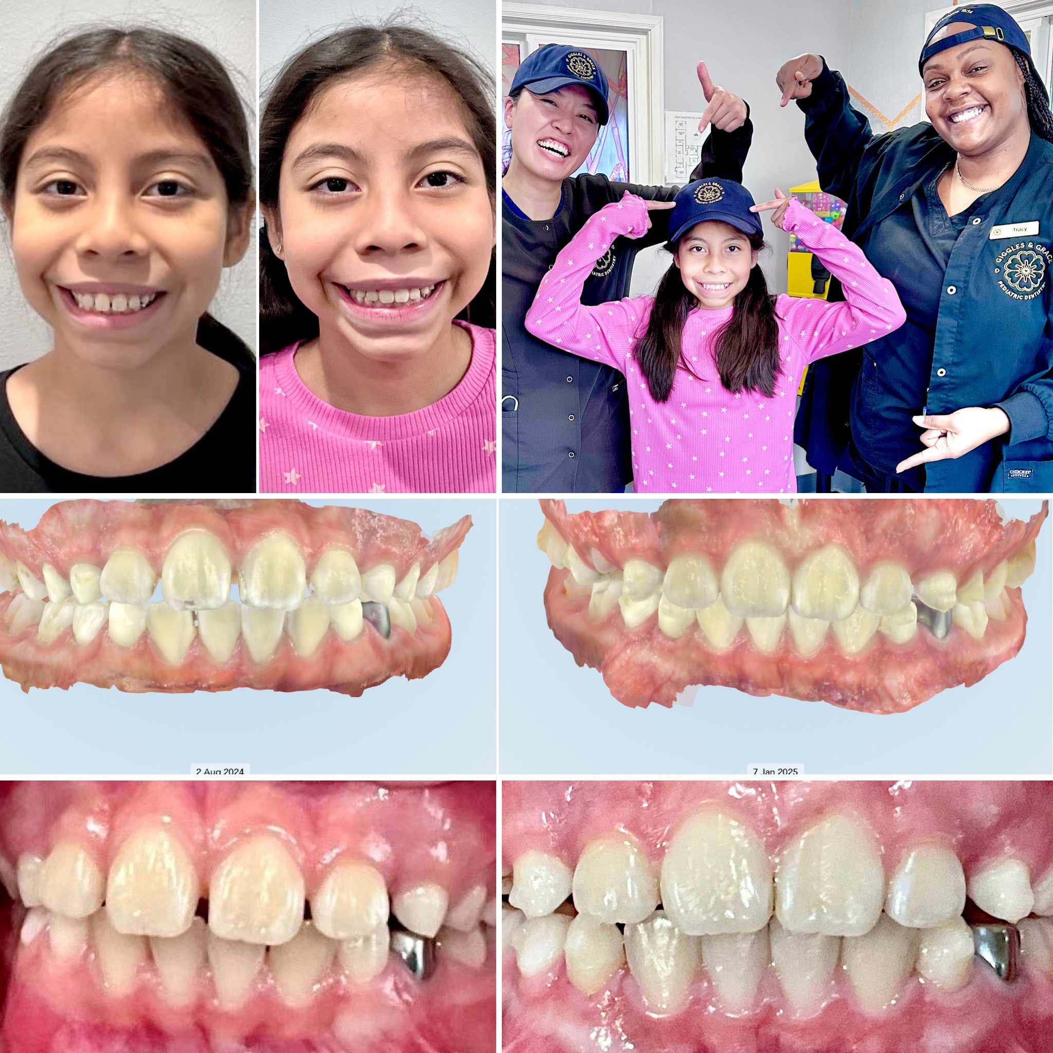 A before-and-after photo showing a child's 5-month progress with Invisalign First treatment at Giggles & Grace Pediatric Dentistry in Lomita, CA.